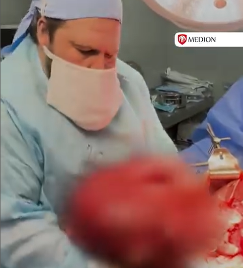 В клинике Medion успешно удалена опухоль весом 28 кг.